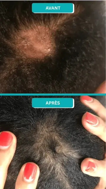 Avant et après d'une cliente Varosia