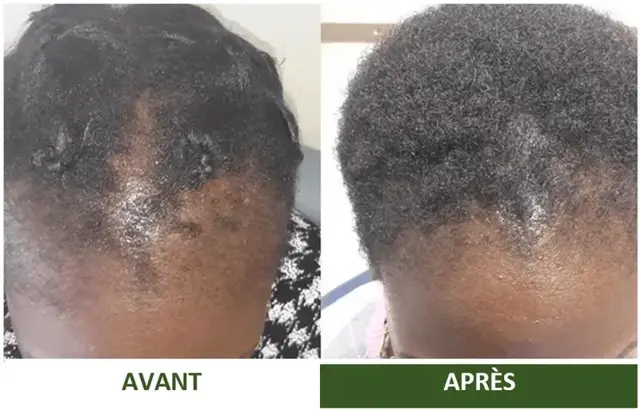 Avant et après d'une cliente Varosia