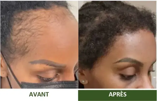 Avant et après d'une cliente Varosia