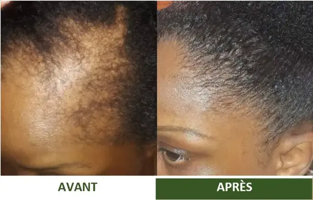 Avant et après d'une cliente Varosia