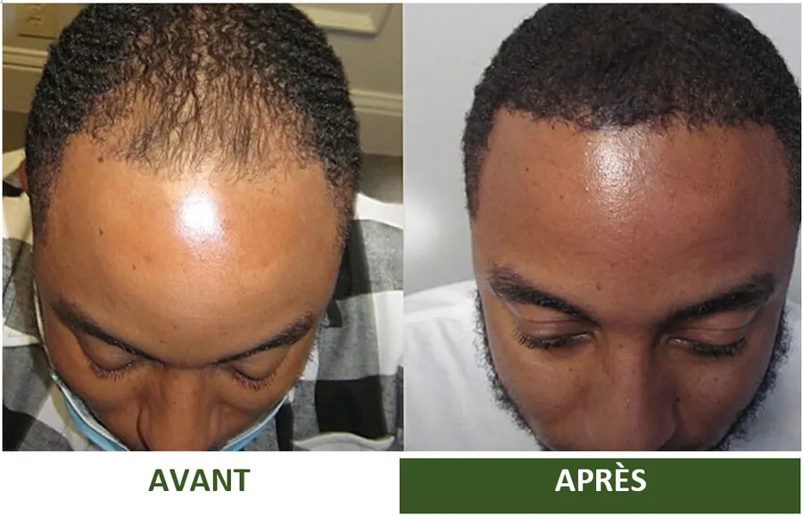 Avant et après : résultat partagé par une cliente