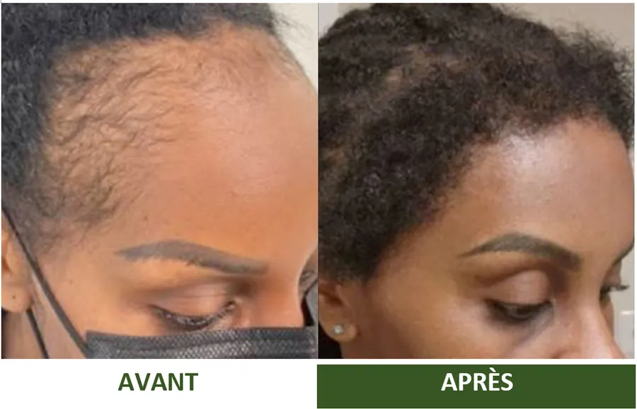 Avant et après : résultat partagé par une cliente